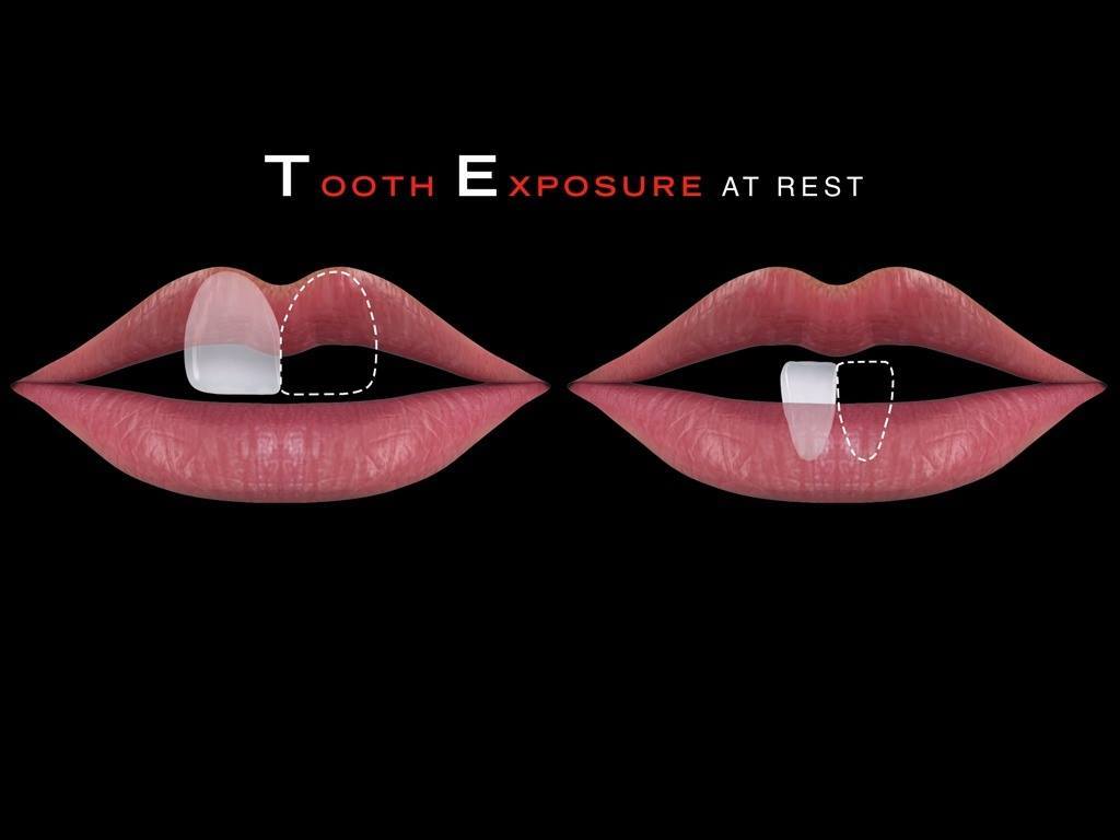How to detect the upper and lower tooth exposure at rest. | Mauro Fradeani