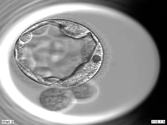 This is the last genetrically-tested-normal embryo that we have. Embryo ...