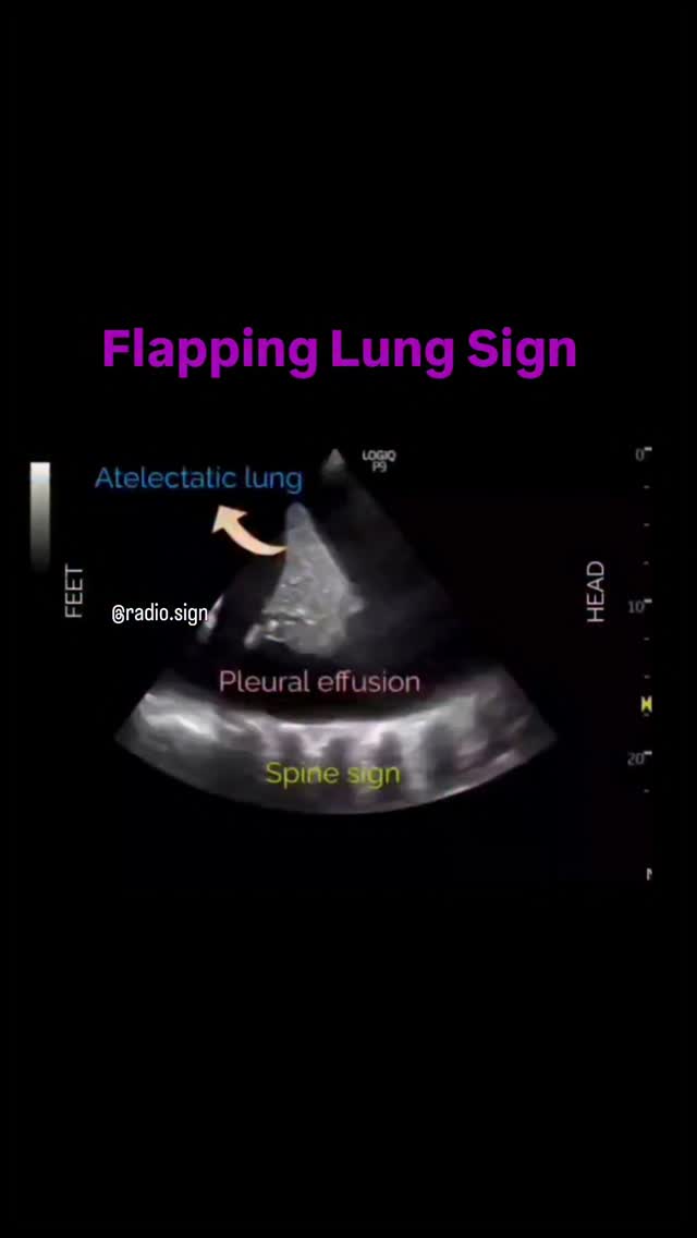 The Flapping Lung Sign, also known as the Jellyfish Sign, is a dynamic ...
