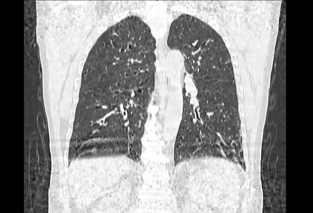 Bilateral pulmonary mild diffuse interstitial reaction mainly basal ...