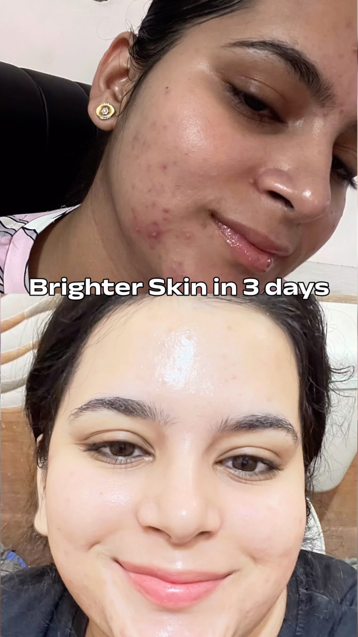 glutathione for acne marks Comment BRIGHT link 🔗 , #explore #skin brightening , Bright skin , serum , skincare , Korean glass skin , , pigmentation, melasma , body brightening | Foxtale Altered behavior, brain structure,