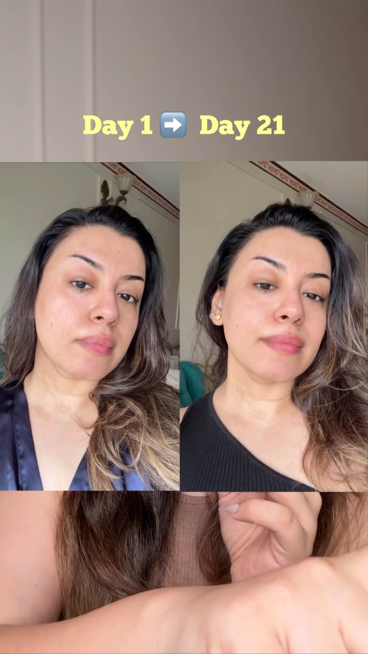 glutathione acne reviews comment ‘LINK’ for product links 💖, I finally took up the 21-day glow challenge on my combination prone skin and the results are right here! No filters as usual just real results 💕 check out the BPC-157, TB-500 & Tesamorelin cleardea Bottle Amount:3 Bottles