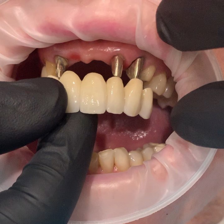 Splinted porcelain bridge supported by the adjacent teeth + a post and ...