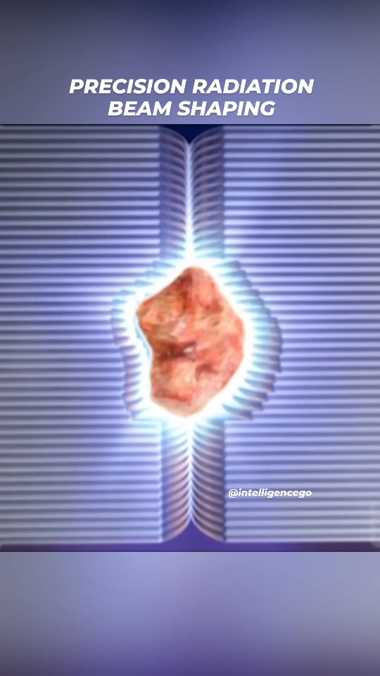 Precision Radiation Beam Shaping - A MultiLeaf Collimator (MLC) is a ...