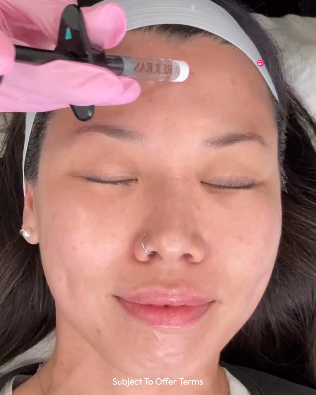 SkinPen Microneedling by LaserAway | LaserAway