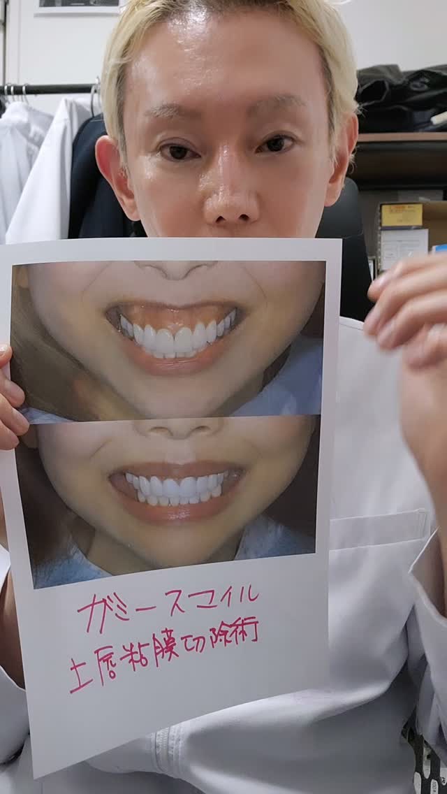 症例解説動画』ガミースマイルを美しくするにはいくつかの方法が