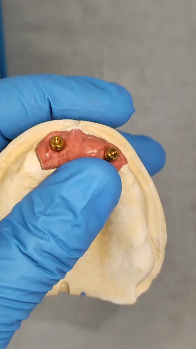 Locator Denture . . . . . #Modellguss #zahntechnik #zahntechniker # ...