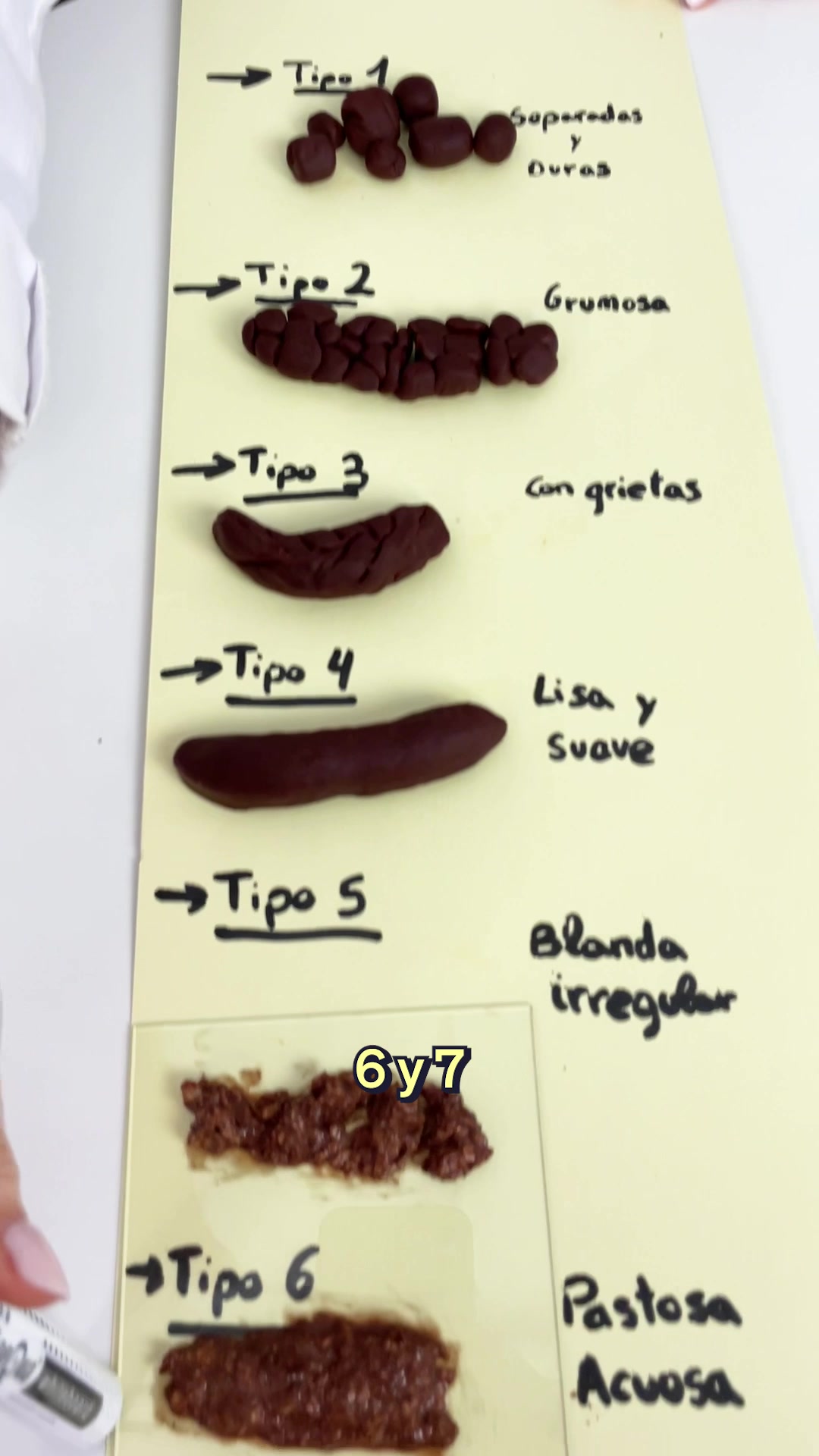 ¡Descubre lo que tus heces dicen sobre tu salud! 🚽💩 Según la Escala de ...