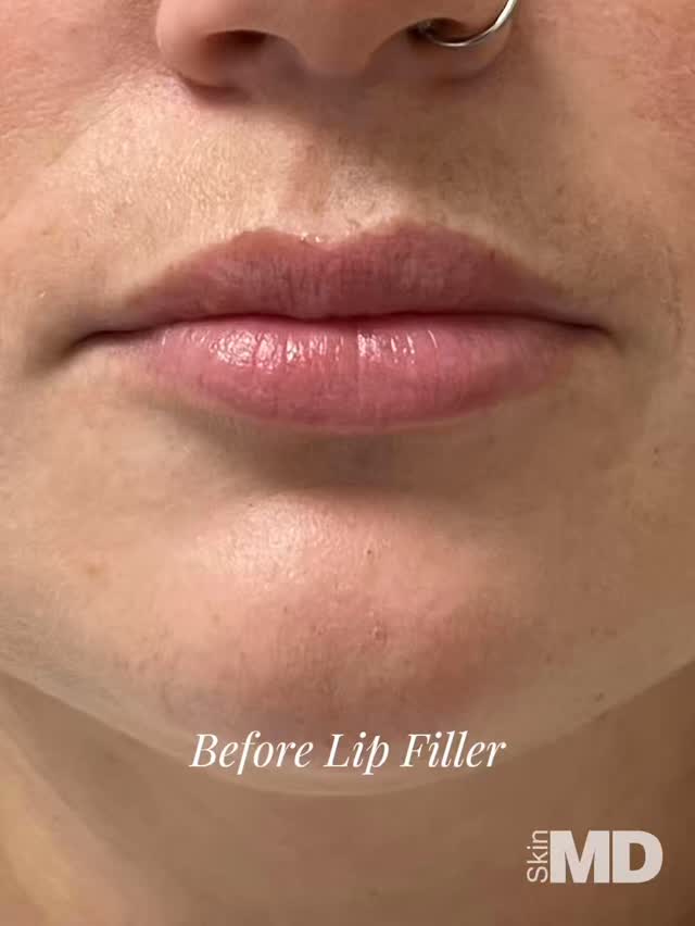 Consider this your sign to book the lip filler 💋, The shape, the volume, the definition… everything ✨, 💉 Lips by MEL B. AESTHETIC NP , #SkinMD #LipFiller #LipGoals #Aesthetics #BeforeAndAfter