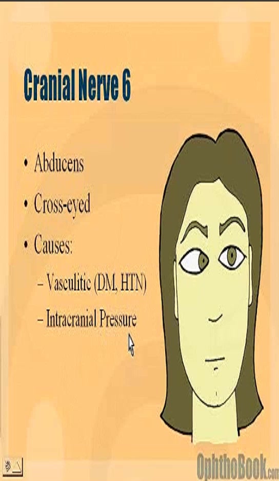 6th nerve palsy - abducens nerve (source Dr Tim Root/ophthobook website ...