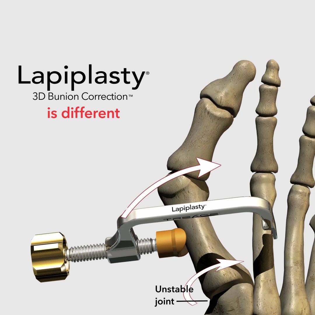 Heard the bad rap about... - Lapiplasty 3D Bunion Correction | Facebook