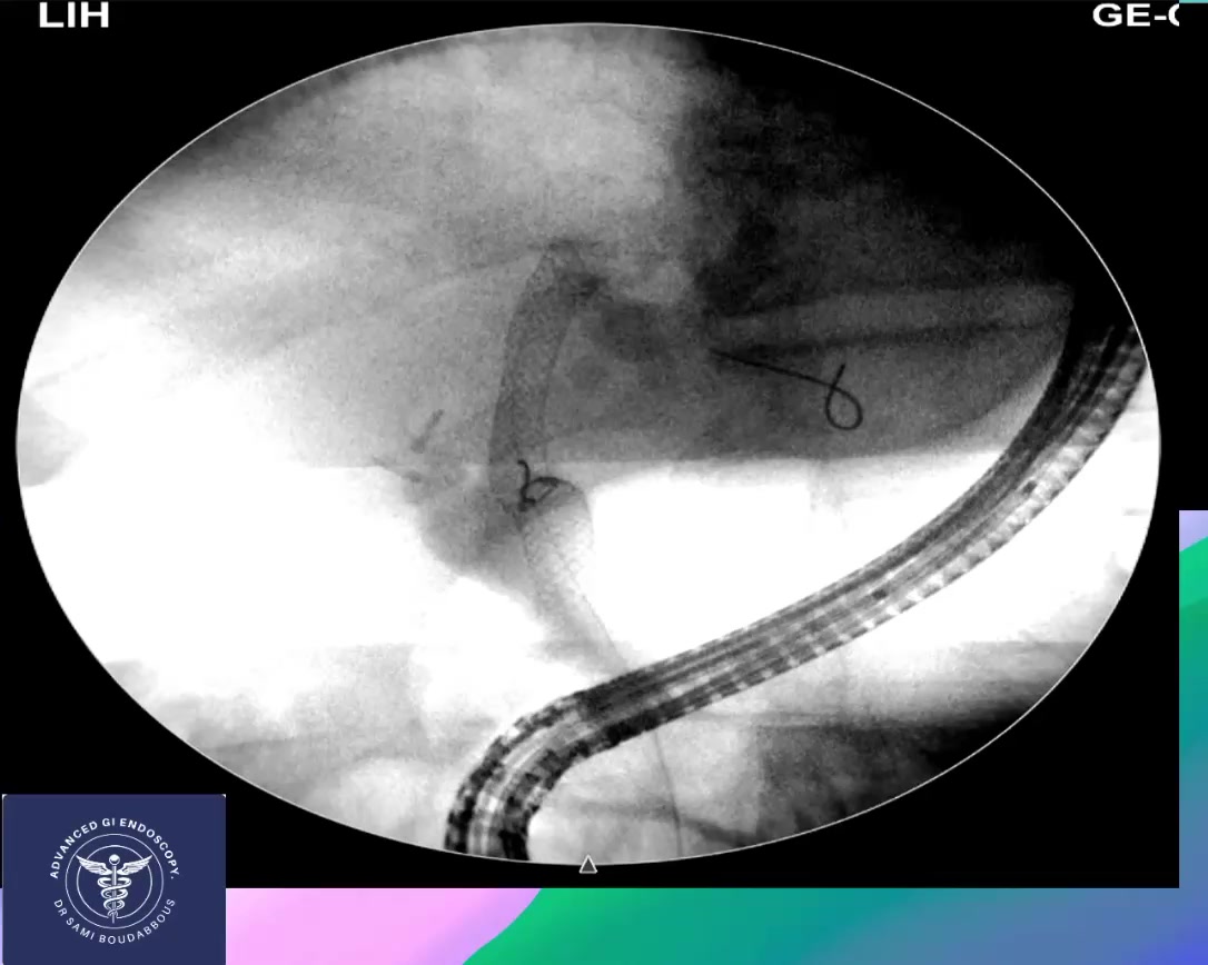 New endoscopic treatment for gastric and intestinal obstructions