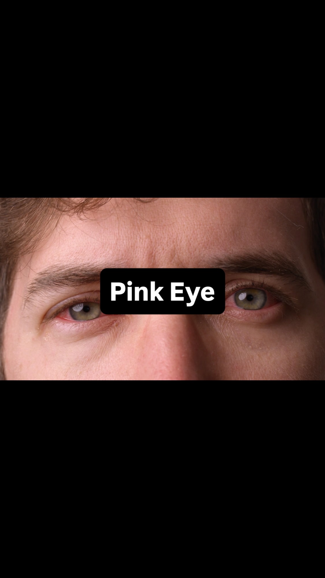 Pink eye, or conjunctivitis, occurs when the clear membrane that covers ...