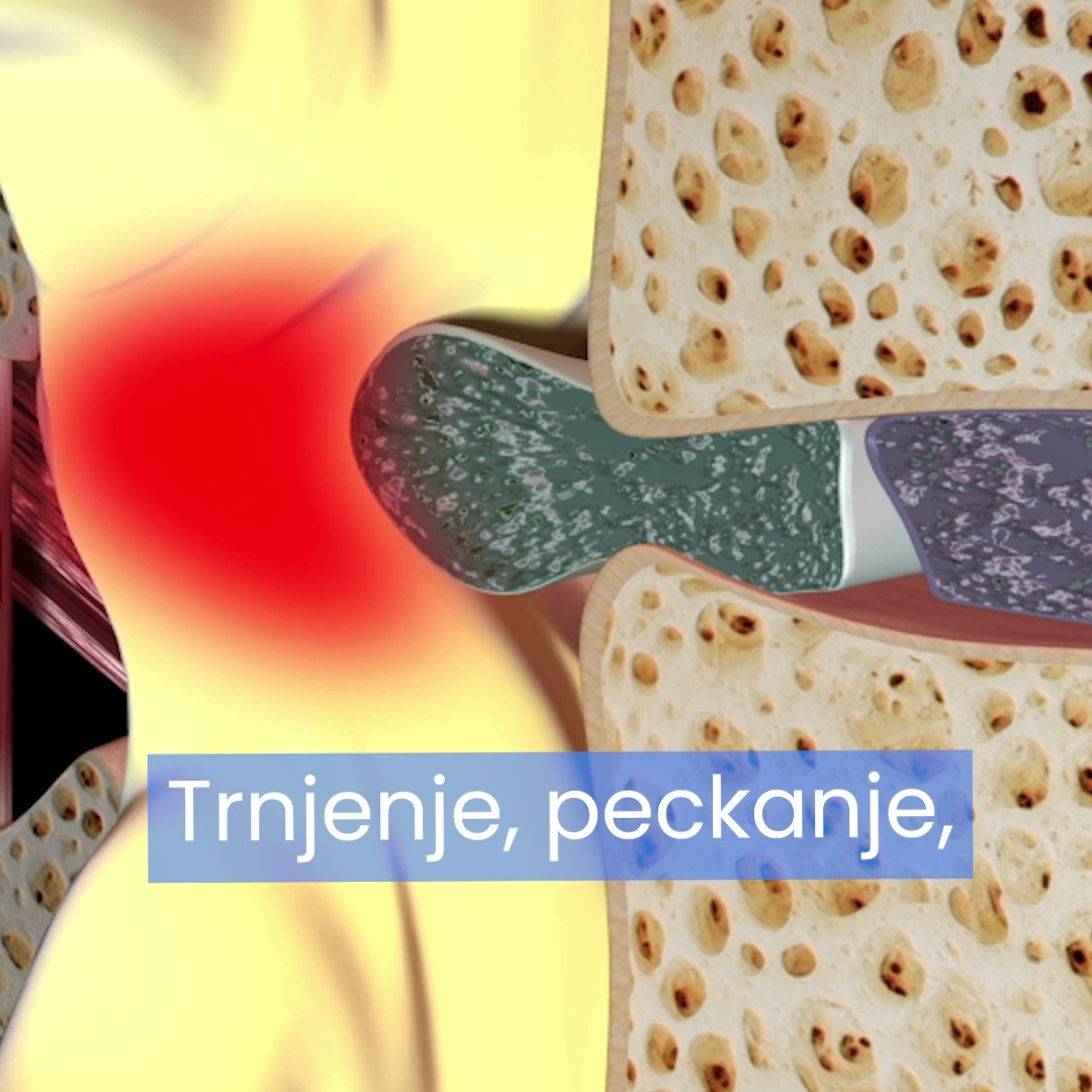 🟥Ukoliko vam je već postavljena dijagnoza diskus hernije ili protruzije ...
