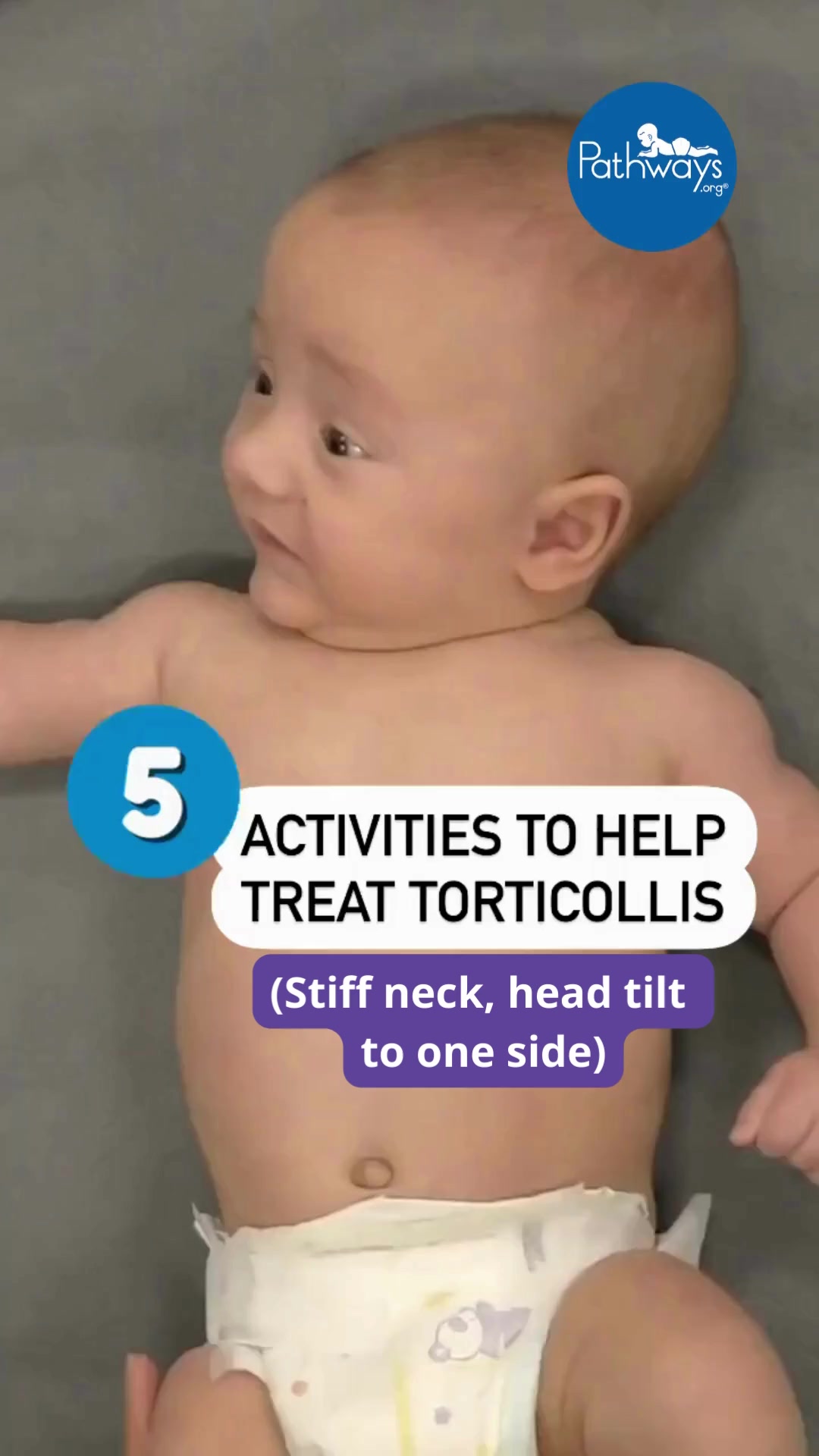 When baby has torticollis (baby’s neck becomes stiff or tight, which ...