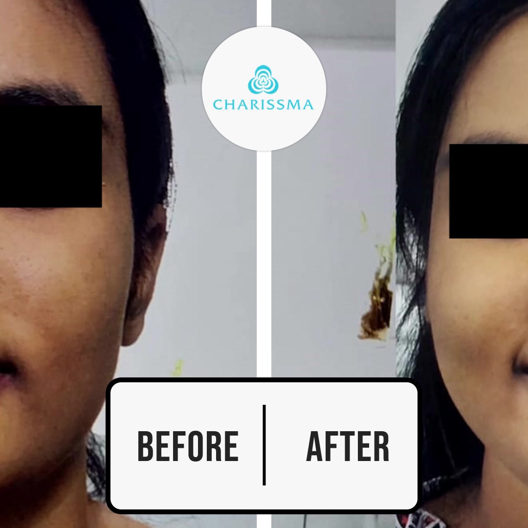 Whiten and brighten your skin in a completely safe and healthy way with Advance Glutathione Treatment! Call now @ +91 98403 16273 to book your appointment & to discuss the treatment options., 