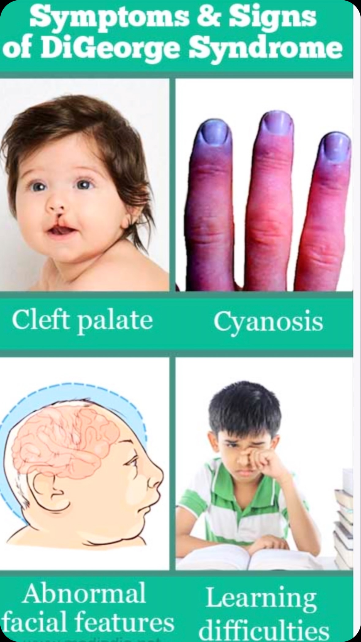 DiGeorge syndrome = deletion on chromosome 22q11.2 Can cause: 1. Heart ...