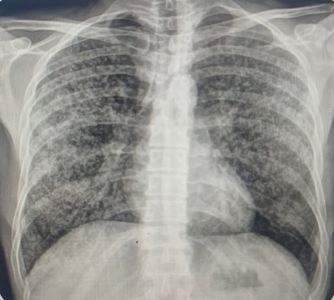 Miliary tuberculosis 🫁 Prolonged low-grade fever, weight loss, night ...