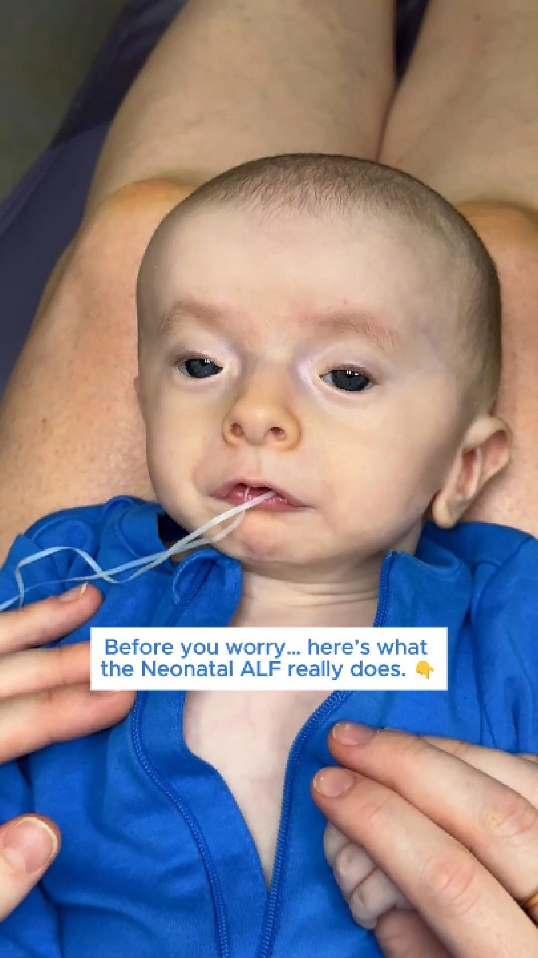 Many parents see the Neonatal ALF for the first time and immediately ...