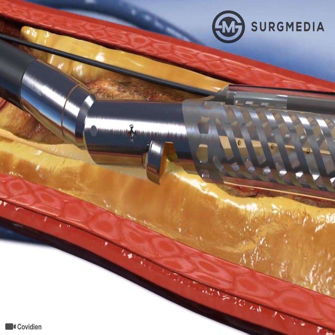 TurboHawk Peripheral Plaque Excision System: Directional Atherectomy ...