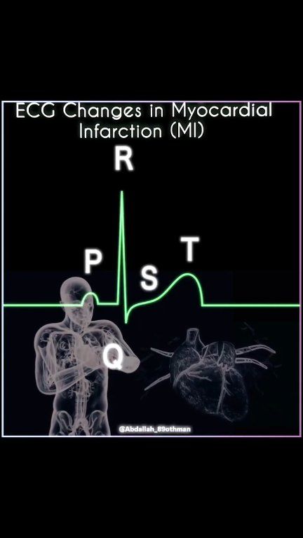 🫀MI ECG Timeline: 👇🏻 Acute ST elevation (hrs), pathological Q waves ...