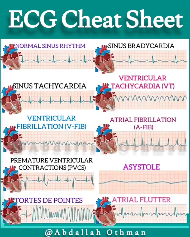 📈 ECG Cheat Sheet 🎯 Drop a ️ 🤓 if you find this helpful! Feel free to ...