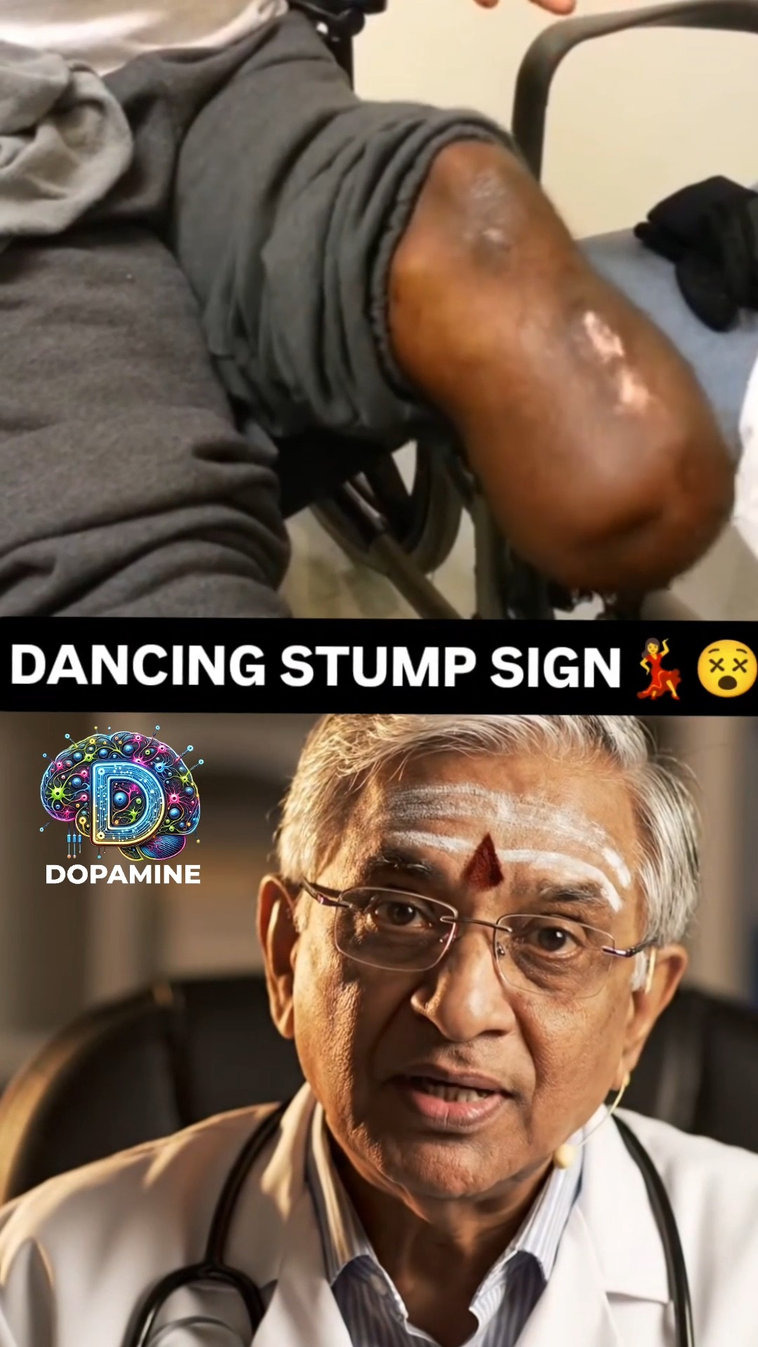 Dancing Stump Sign: Rhythmic movements after limb amputation can hint ...