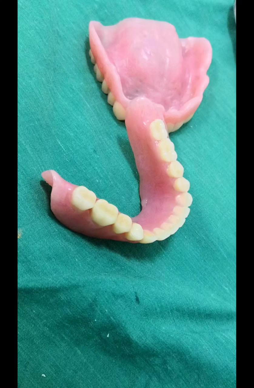 Simplified functionally generated path technique for complete dentures