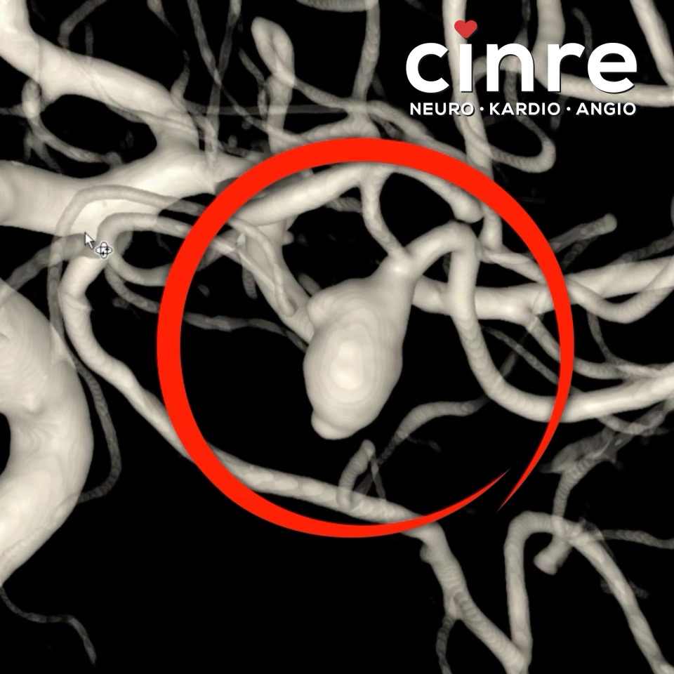 Neuroembolizačné ošetrenie rizikovej, disekujúcej aneuryzmy ...