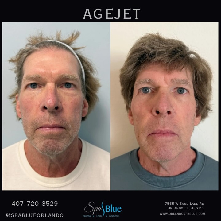 tirzepatide no-downtime skin contouring timing Exion Before and After: Real Results, What to Expect Forma Skin Tightening Treatment Near