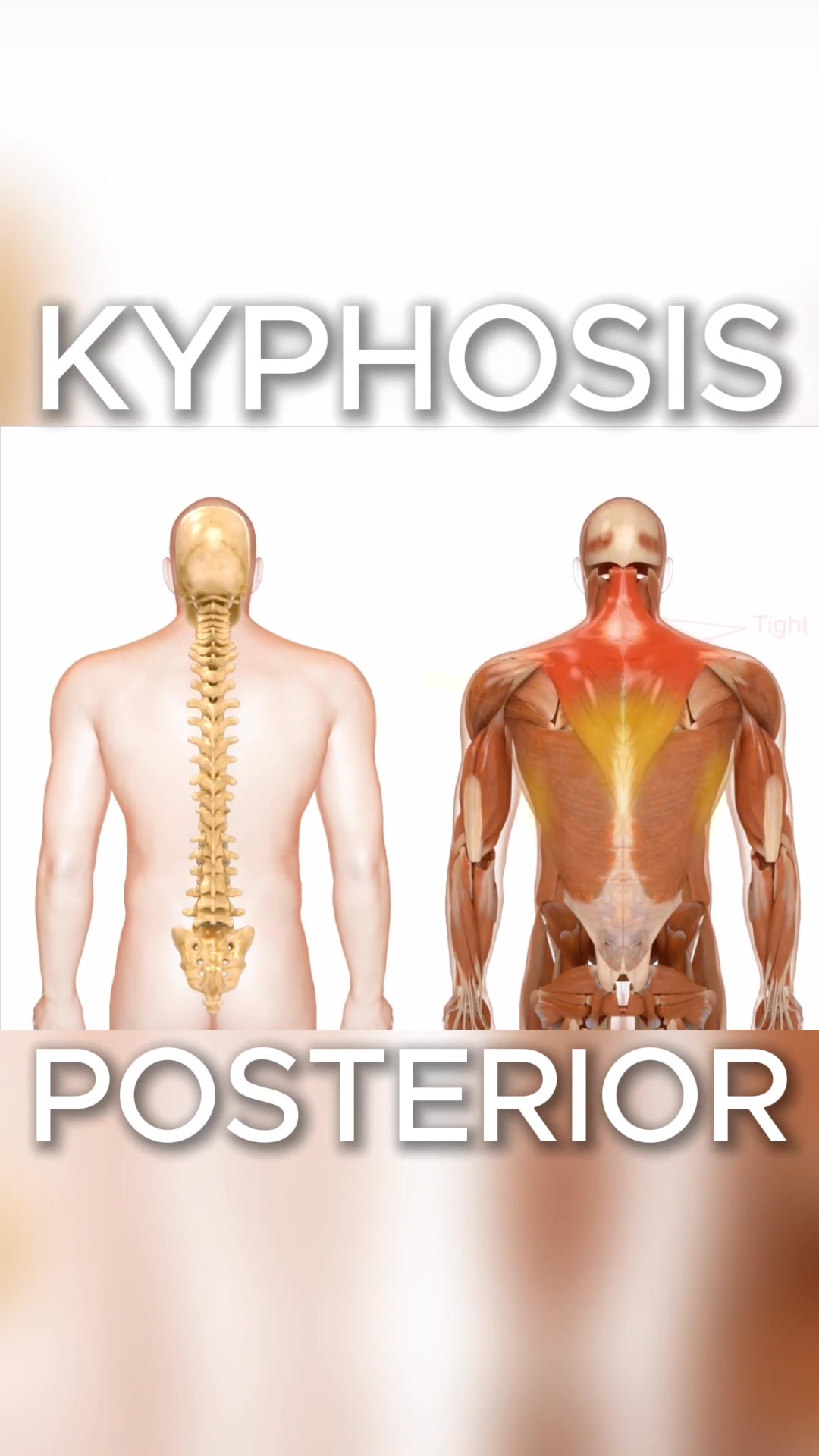 Kyphosis is the forward rounding of the upper back, often caused by ...