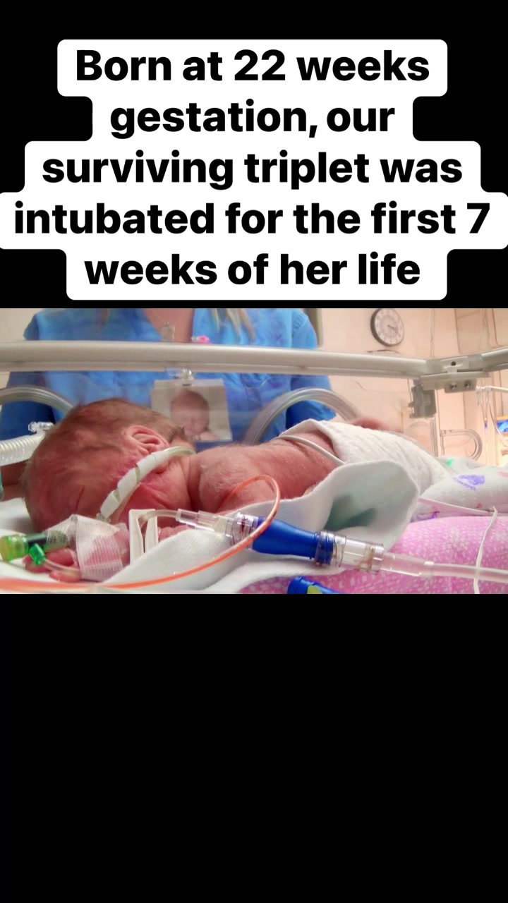 Heartwarming moment! Our 22 weeker surviving triplet spent her first ...