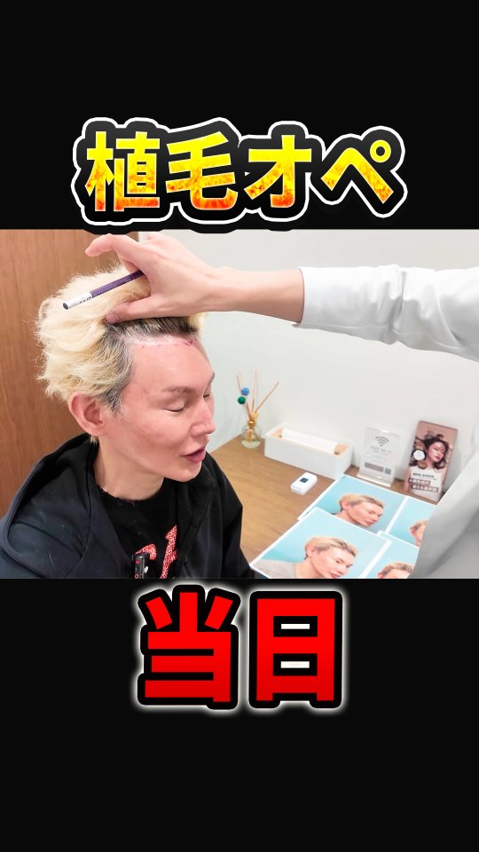 ダイヤモンド今井院長ついに植毛に挑む！ヘアーオブトーキョー様、竹口