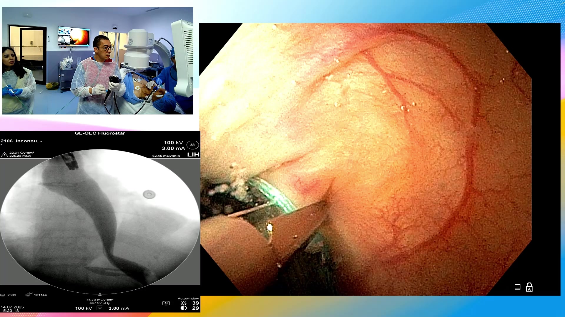 New endoscopic treatment for gastric and intestinal obstructions