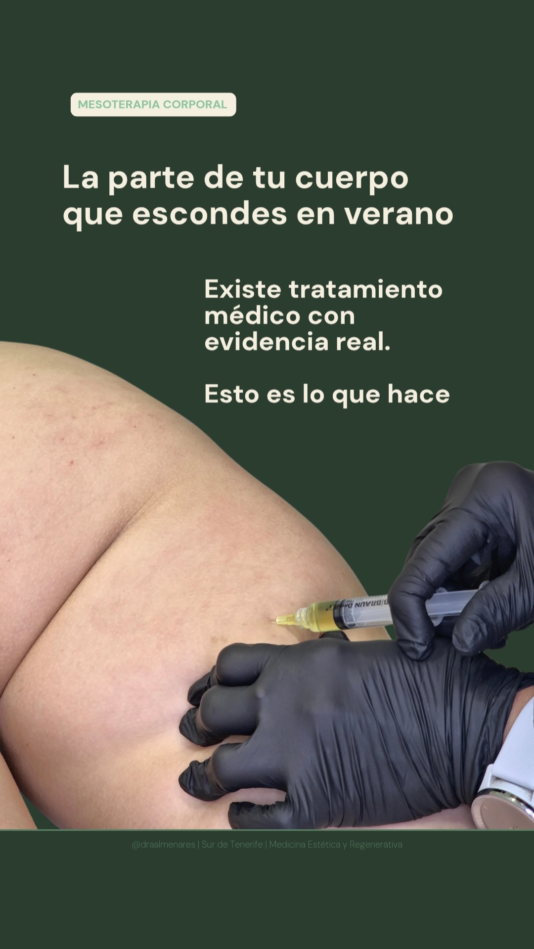 como inyectar l carnitina en las piernas La parte posterior de es una de las zonas que más preocupan y la que menos resultados da con solo ejercicio., La celulitis y la flacidez esta zona tienen un componente estructural que Buy Nascobal Nasal Spray Options:Cream + Facewash Glutathione 500mg for daily use