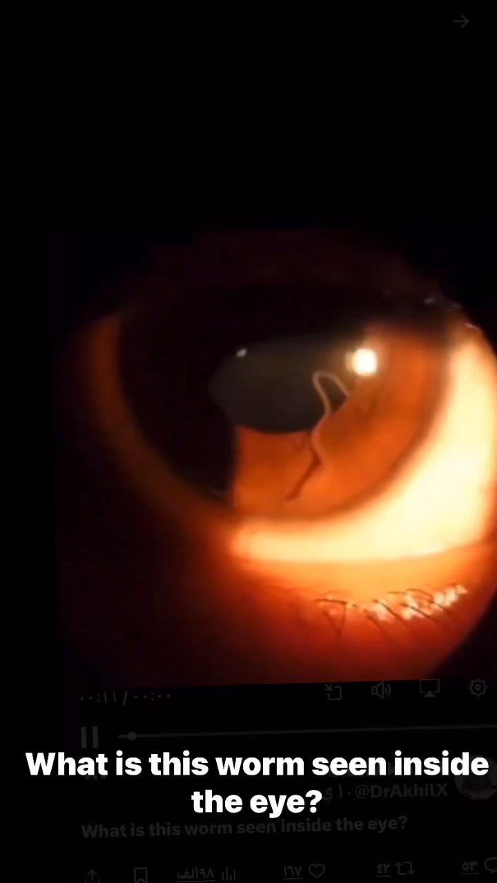 Cardiophilia - What is this worm seen inside the eye? | Facebook