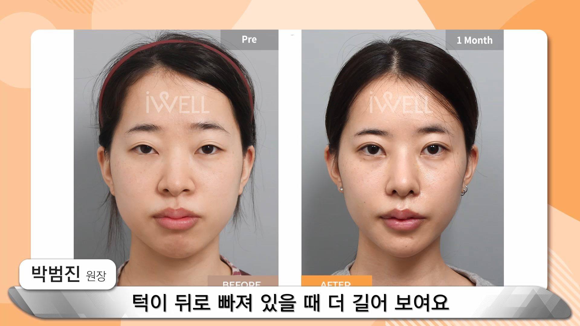 무턱은 심한데...양악수술은 못한다면..!! 아이웰 턱끝전진술로 완벽해결! | #무턱 도 심한데 이마까지 뒤로 빠져 있다면 ...