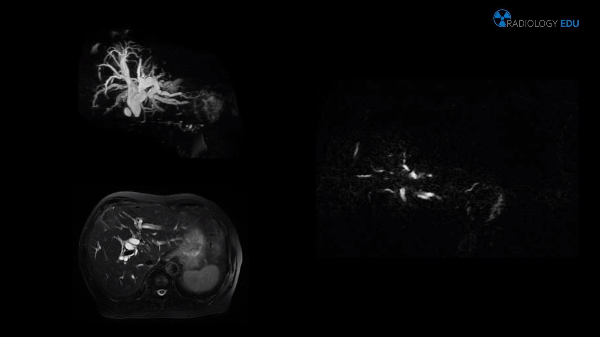 Magnetic resonance cholangiopancreatography (MRCP) on a patient with ...