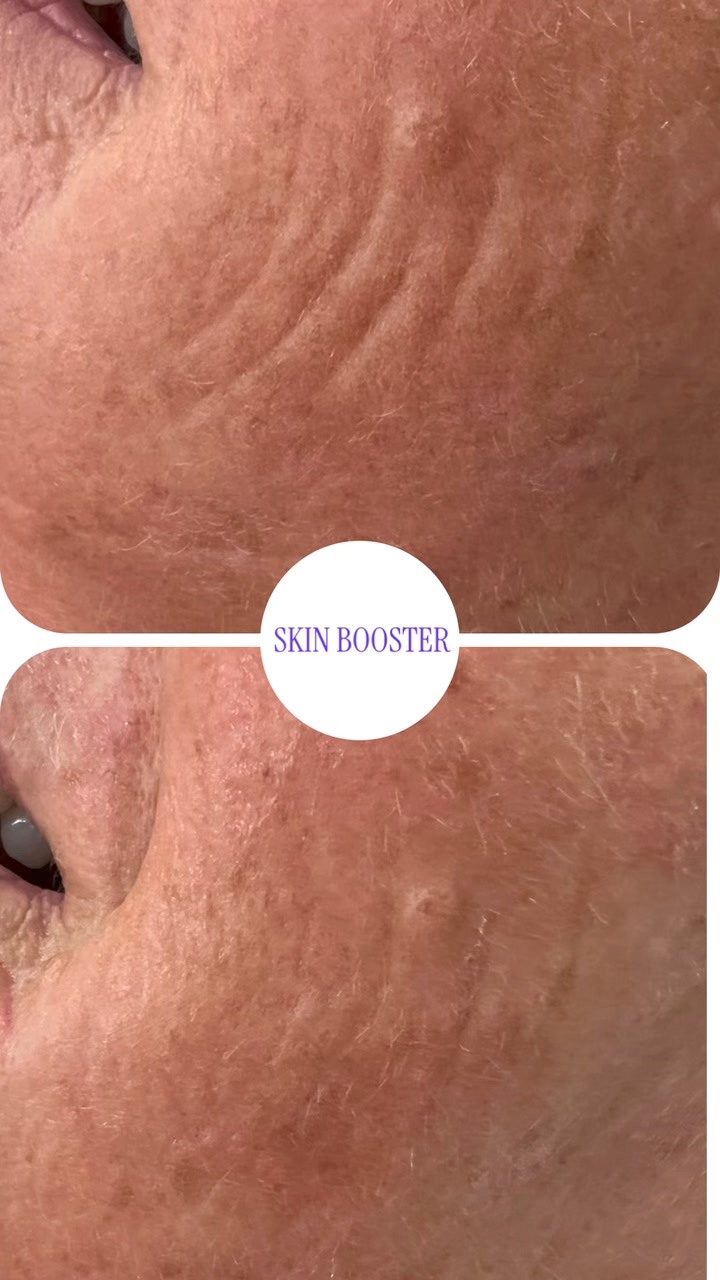 lumi glutathione review before and after Pro Skin Booster Lumi Eyes Before and After