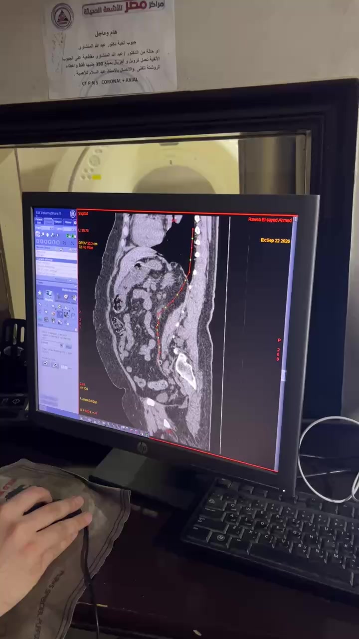 In a CT Abdomen & Pelvis scan, the term Extension refers to