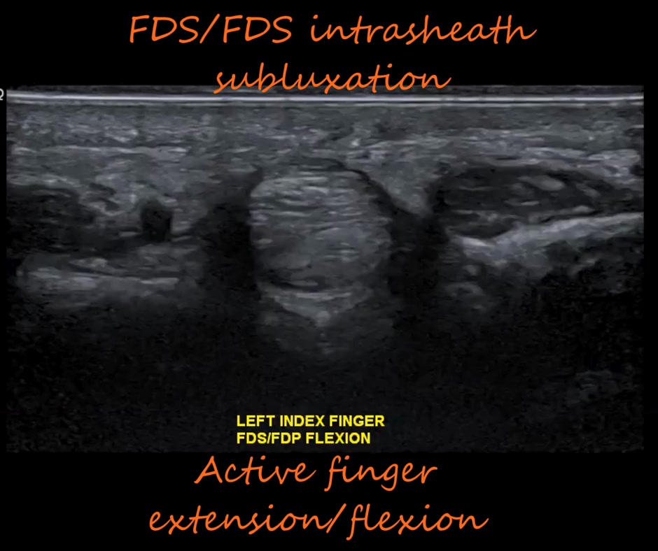 FDS & FDP tendon subluxation demonstrated with dynamic ultrasound. Real ...