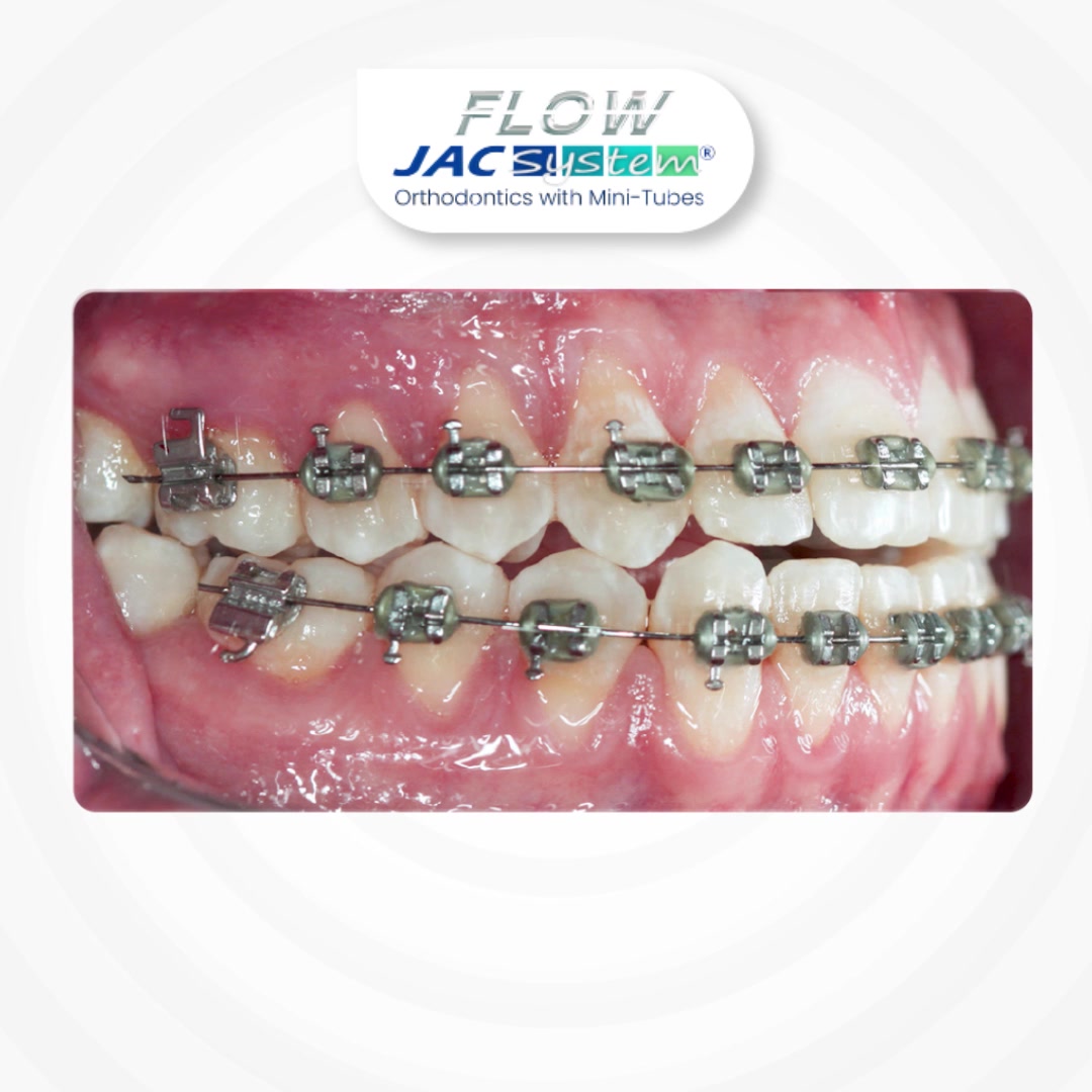 En Flow Jac System®, la individualización y el movimiento secuencial ...