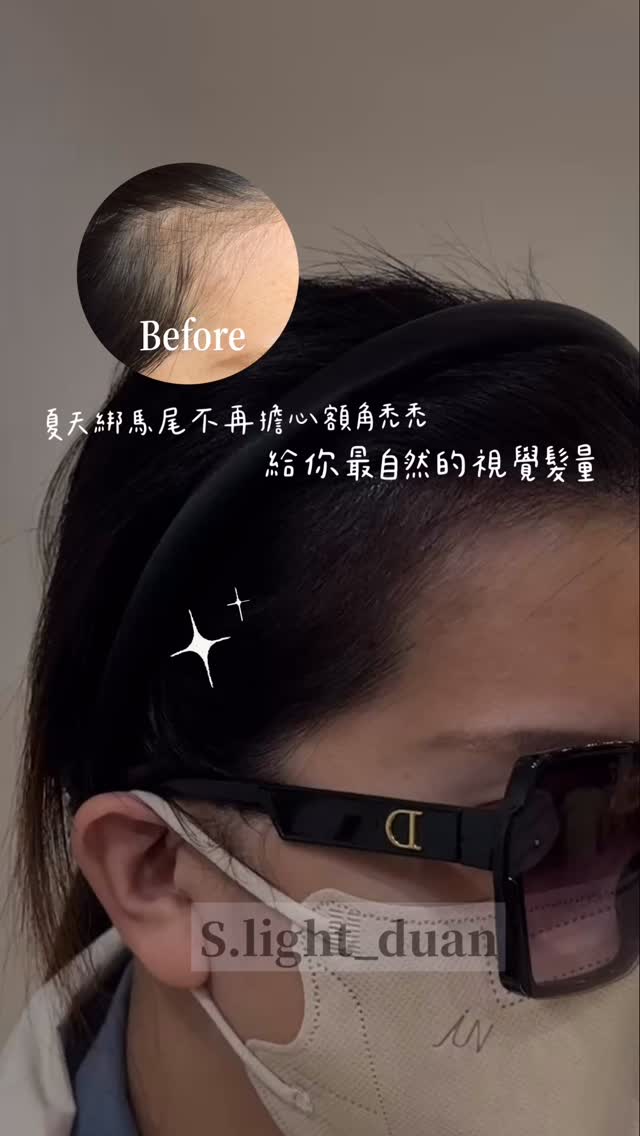 誰適合紋額角？ 額角後退的人 髮際線不對稱的人 想要小臉效果的人 想要氣質更精緻的人 🌟SMP 紋額角 · 讓自信從髮際線開始 #smp紋髮 ...