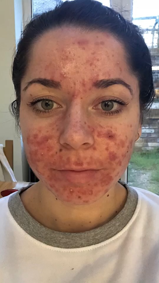 glutathione acne worse Doctor said my skin is the she has ever seen #reels #viral #borndifferent #truly #skin #acne | Born Different Gift Idea