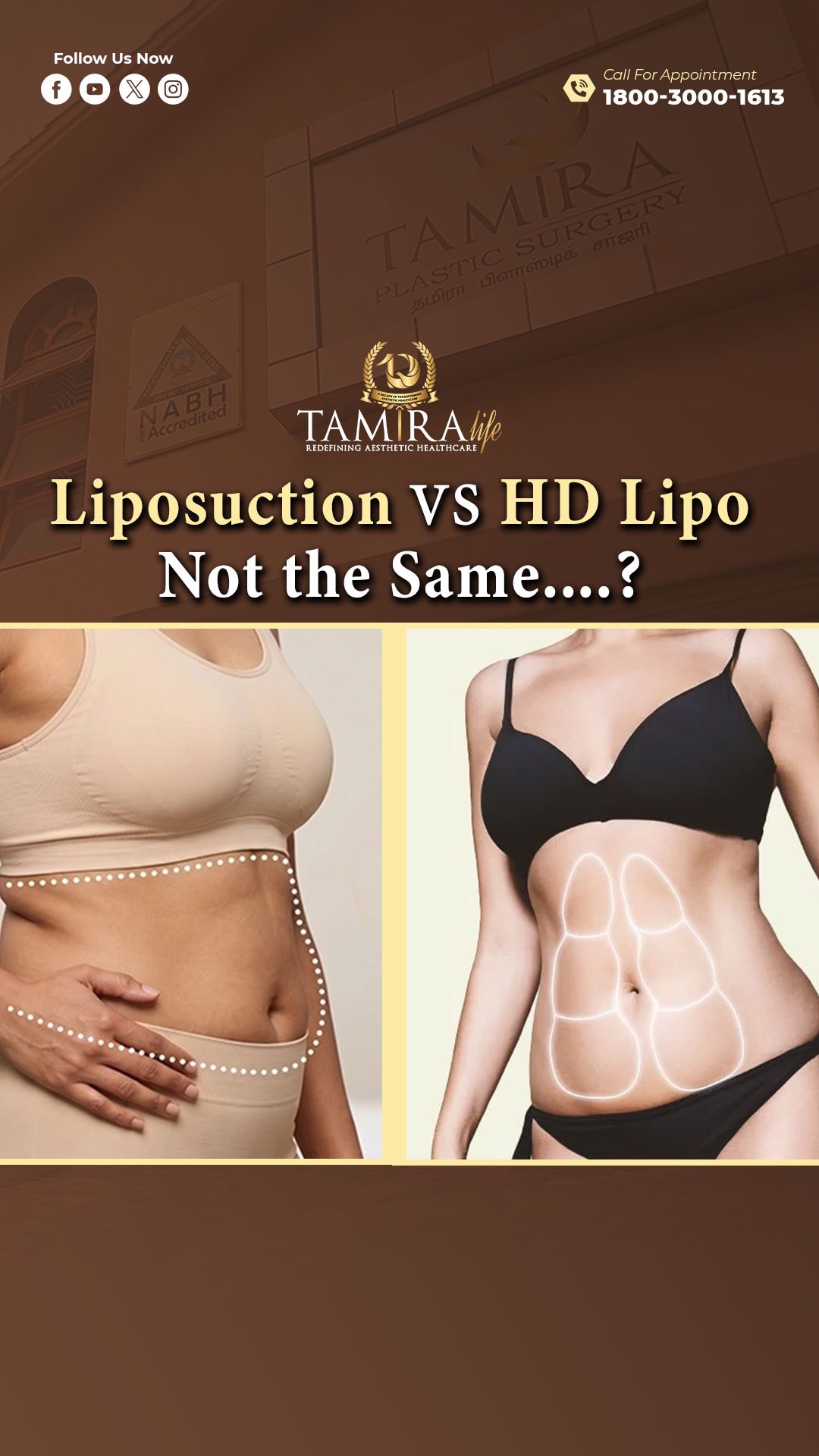 lipo c hockley Liposuction vs High-Definition Liposuction: What’s the Difference?, Liposuction removes unwanted fat. High-definition liposuction goes a step further by strategically contouring fat around anatomical За проблемою_Розширені пори Wellness Rewind Copper Peptide Size:18 Sachets