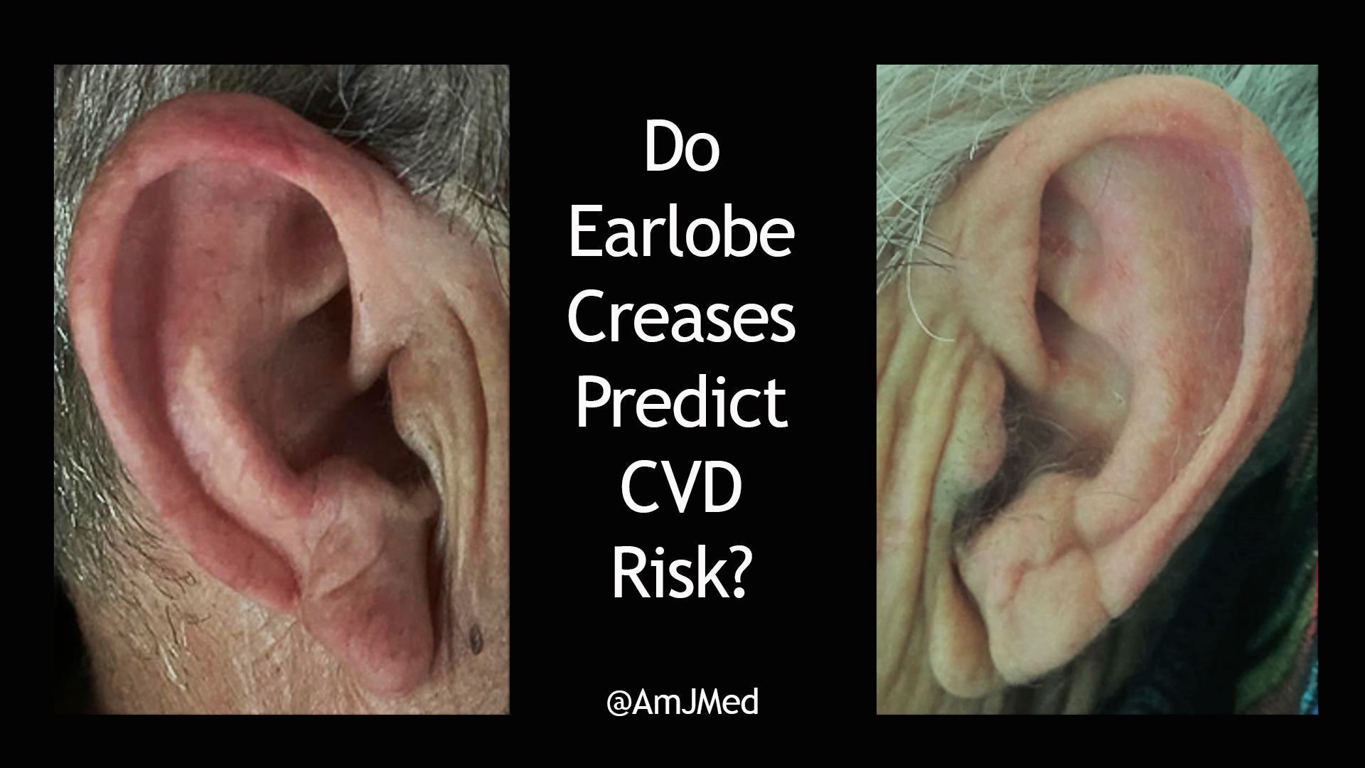 For decades, earlobe creases have been a noted as a potential physical ...