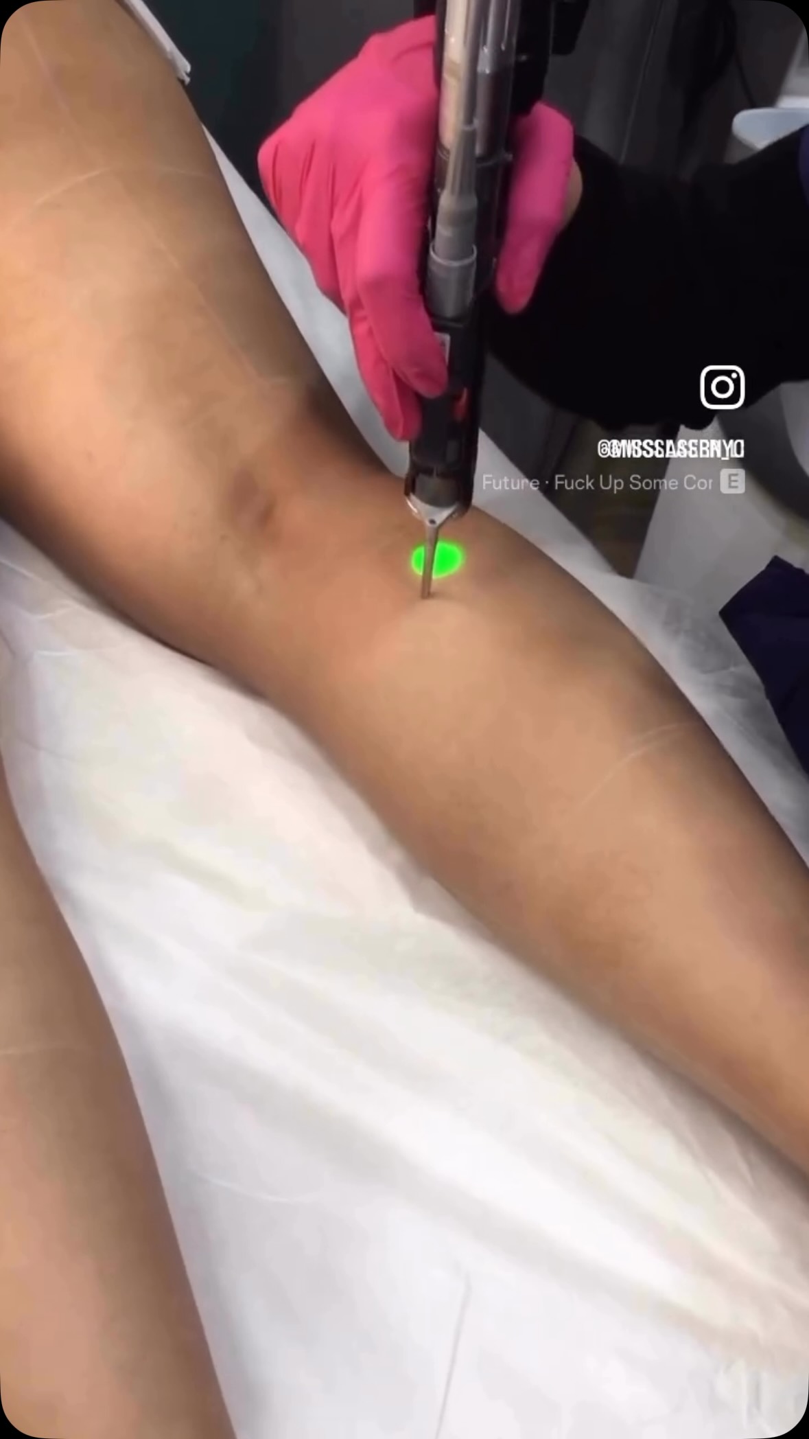 glutathione razor bumps Still shaving this summer? ☀️, Don’t spend another season worrying about bumps, ingrown hairs, or stubble. , Start your laser hair removal journey now and enjoy smoother leg Ann Shippy, MD - Size:5gm تونر بزيت الزيتون