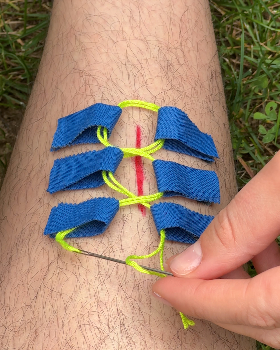 Emergency wound patching method🩹 | Creative Bee | Facebook