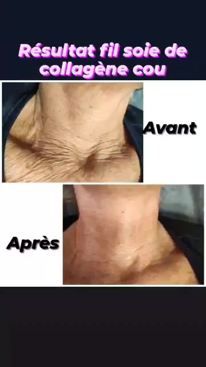 Fils De Soie Collagène Avant Après