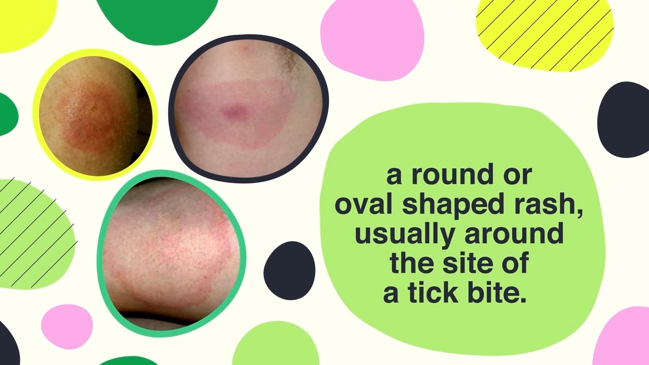 👀 The Erythema Migrans (EM) rash is one of the most recognisable signs ...